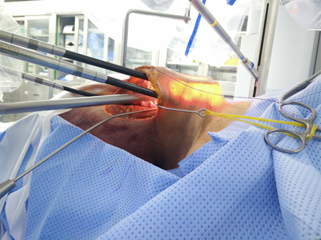Thyroid Surgery